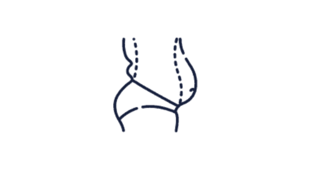 Abdominoplasty